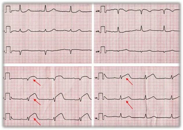 Экг подъем. Элевация сегмента St v1-v3. Подъем сегмента St на ЭКГ v1 v2. Подъем сегмента St на ЭКГ v1 v2 v3. Элевация St в v1-v3.