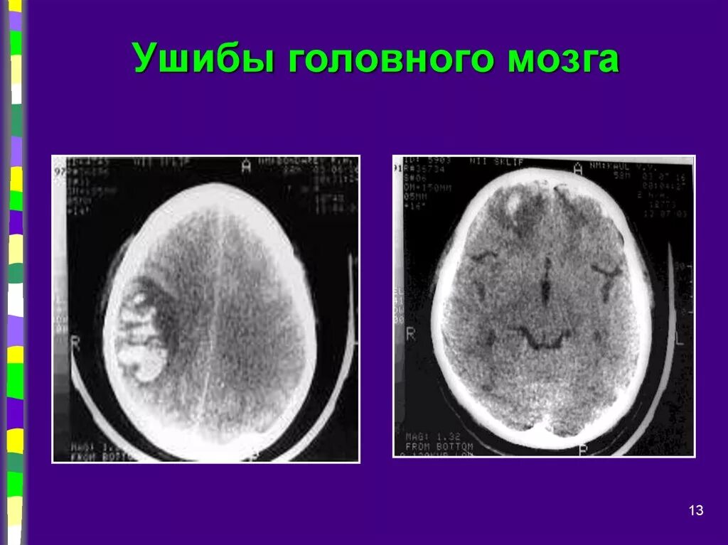 Локализация ушиба головного мозга. Ушиб головного мозга легкой степени. Закрытые травмы головного мозга. Диагностика сотрясения