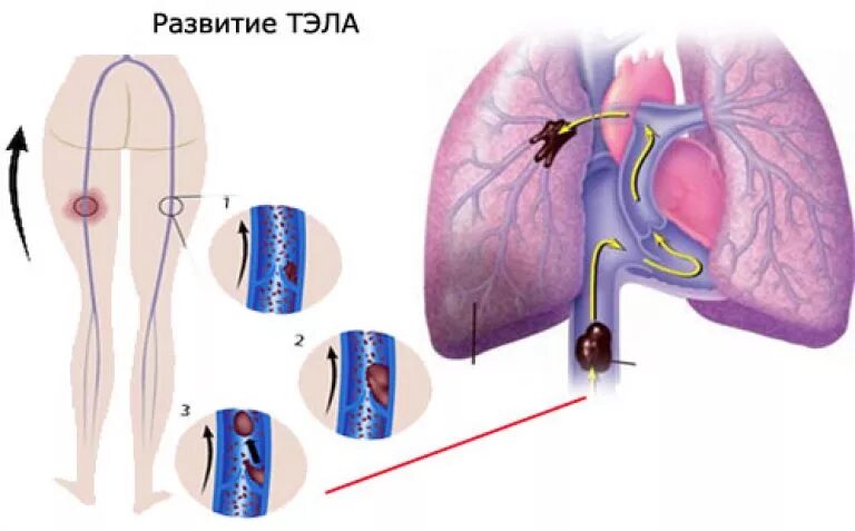 Тромбоэмболия легочной артерии. Тромбоэмболия легочной артерии (Тэла). Тромбоэмболия легочной артерии осложнения. Тромбофлебит легочной артерии