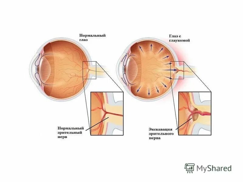 Глаукома схема. Строение глаза при глаукоме.