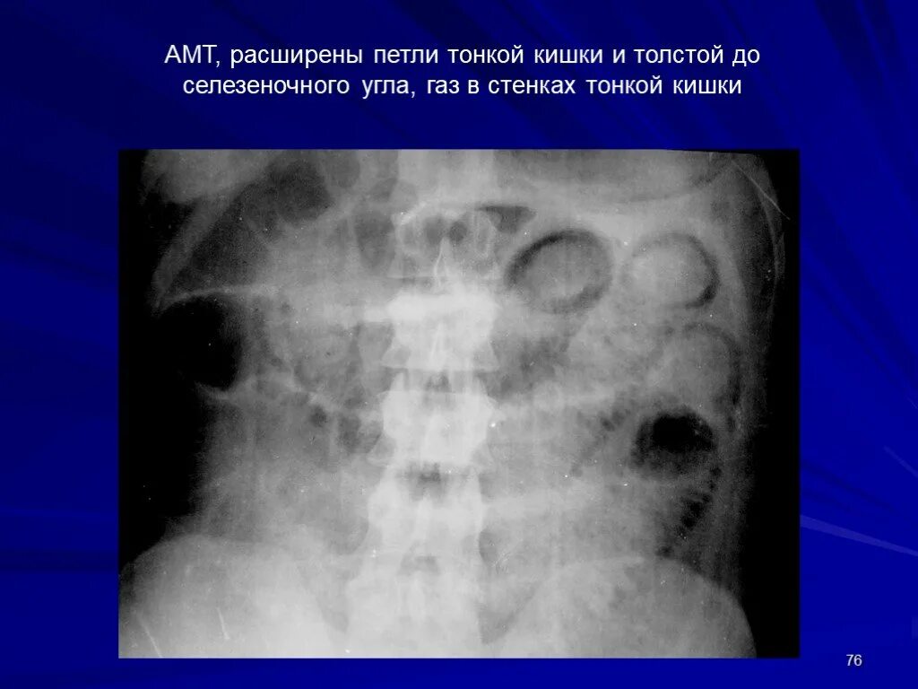 Расширение петель кишечника на рентгене. Рентгеноанатомия тонкого кишечника. Расширение кишечных петель рентген. Петли кишечника на рентгене. Расширение петель кишечника