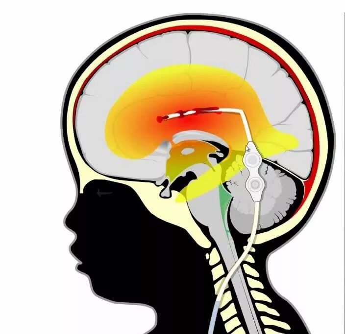 Гидроцефалия шунтирование мозга. Шунтирование гидроцефалии головного. Шунтирование желудочков мозга. Шунтирование головного мозга при гидроцефалии.