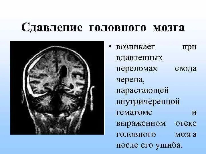 Травматический отек мозга. Сдавление головного мозга. Сдавление костей черепа. Сдавление головного мозга при переломе свода черепа.
