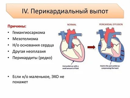 Жидкость в сердце причины