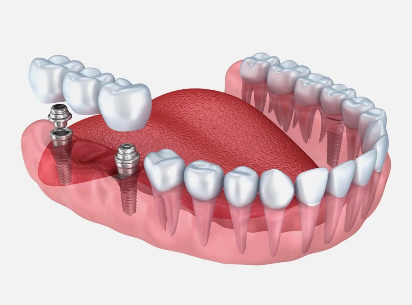 Мостовидный протез на имплантах на 4 зуба. Мостовидный протез на 6 имплантах. Зубной имплантат Dio. 3 зуба установить
