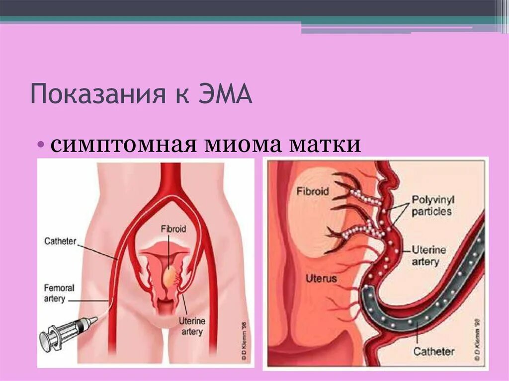 Эма миомы матки. Миома и менопаузальный период. показания к эма при миоме матки.