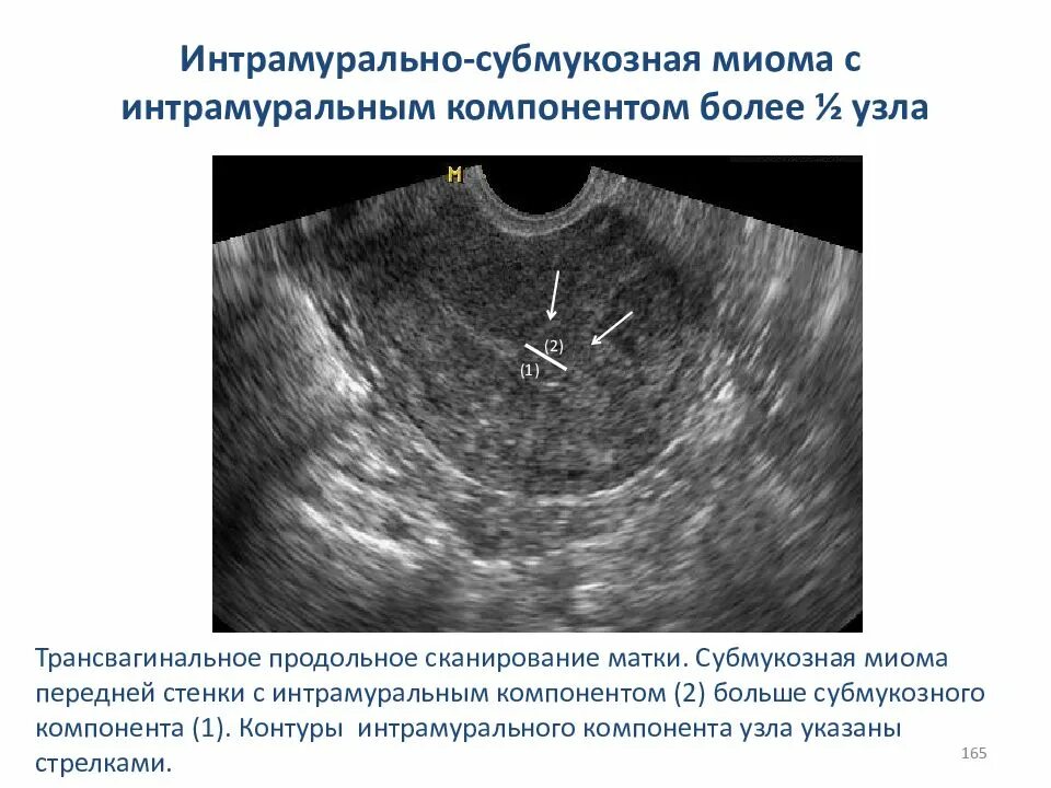 Удаление стенки матки