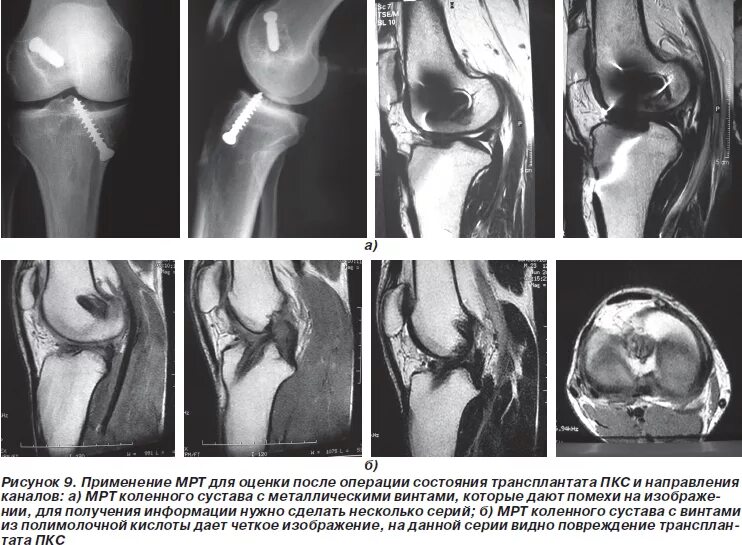 Мениск коленного сустава рентген. Капсулит коленного сустава мрт. Аутопластика ПКС коленного сустава. Пластика ПКС коленного сустава.