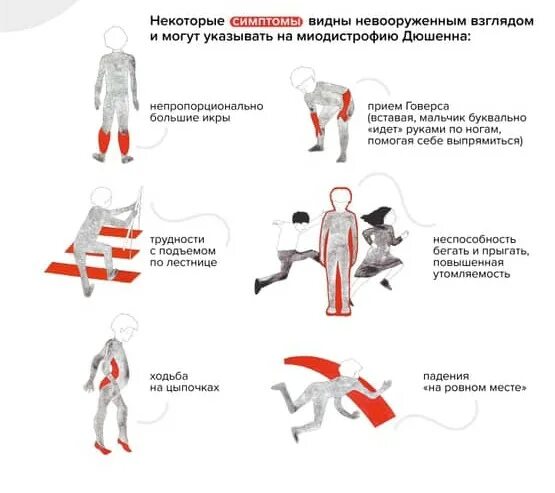 Мышечная дистрофия у детей симптомы. Мышечная дистрофия дюшенна синдромы. мышечная дистрофия дюшенна признаки. прогрессирующая миопатия дюшенна. мышечная дистрофия дюшенна клинические проявления.
