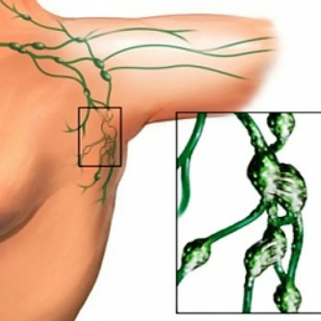 Лимфоузлы под мышками расположение у женщин. Подмышечный лимфаденит. Подмышечные лимфоузлы воспаление. Лимфосистема подмышечная. Воспаление лимфа подмышками.