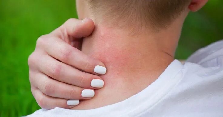 Ça gratte ! 13 astuces pour calmer une piqûre de moustique Picaduras de mosquito