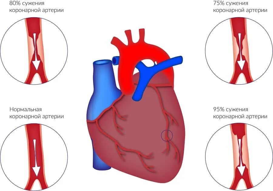 вазоконстрикция периферических сосудов это. изменение просвета сосудов. кровяное давление в сосудах. сужение просвета сосудов. капилляры физиология.