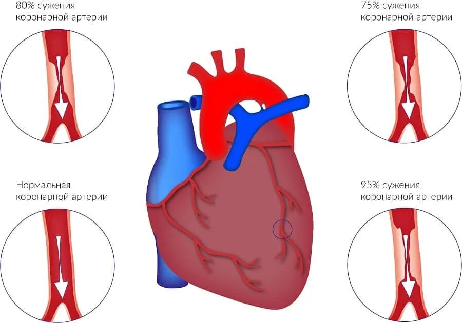 Стеноз венечных артерий сердца. Степени стеноза коронарных артерий в процентах. Атеросклероз аорты и коронарных артерий. Степень сужения венечных артерий. Сужение сосудов симптомы причины