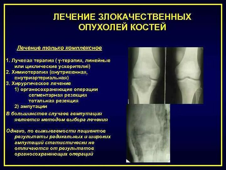 Гигантоклеточная опухоль бедренной кости на кт. Опухоли большеберцовой кости на рентгене. Отек кости лечение. Принципы хирургического лечения опухолей. Гигантоклеточная опухоль кости кт.