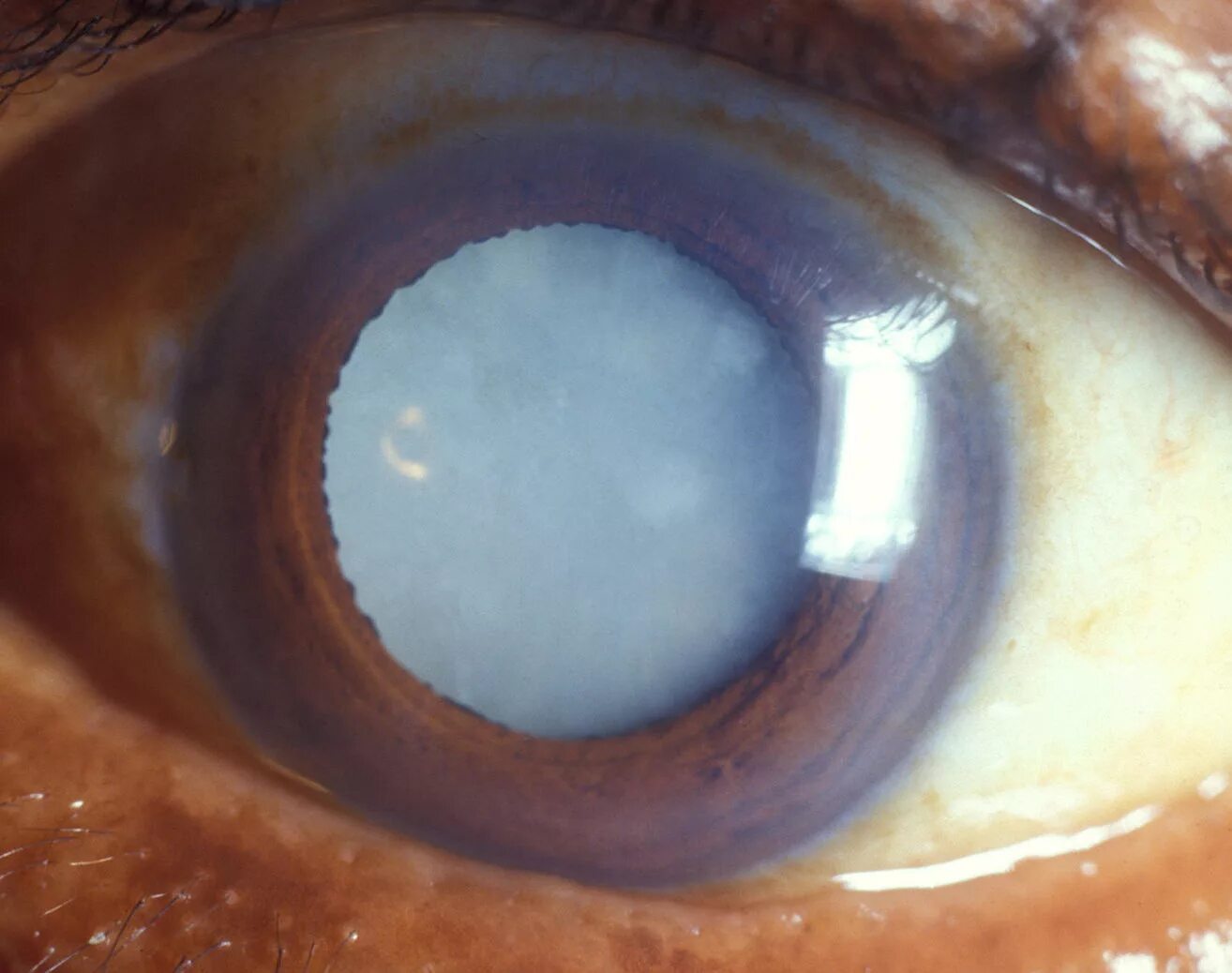 Постувеальная катаракта. Сенильная катаракта глаза. Миопизирующая катаракта. Вторичная катаракта после операции