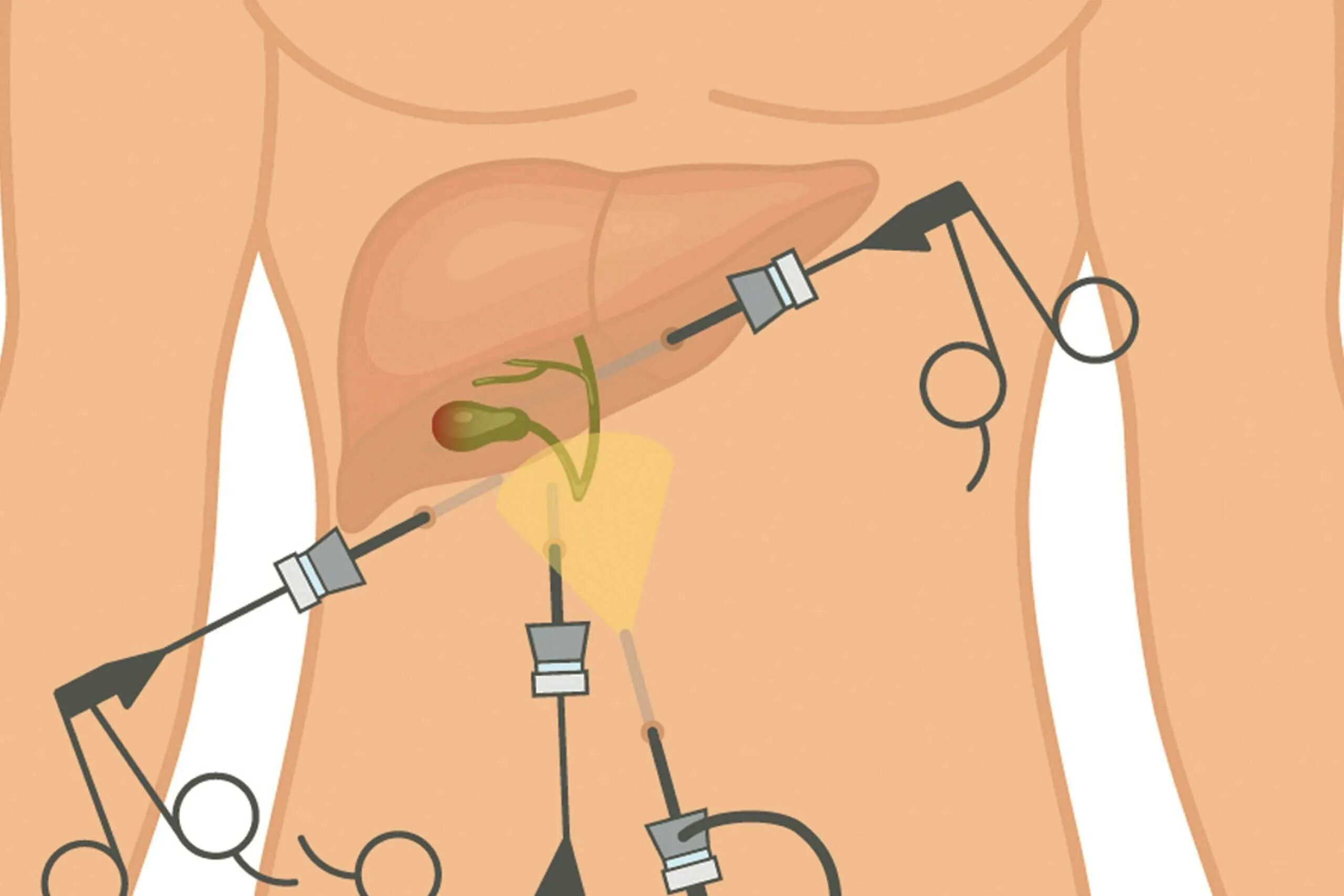 Лапароскопия показания. Лапароскопия желчного пузыря хирургия. Лапароскопия желчного шрамы. Лапароскопическая холецистэктомия схема операции. Лапароскопия холецистэктомия ход операции.
