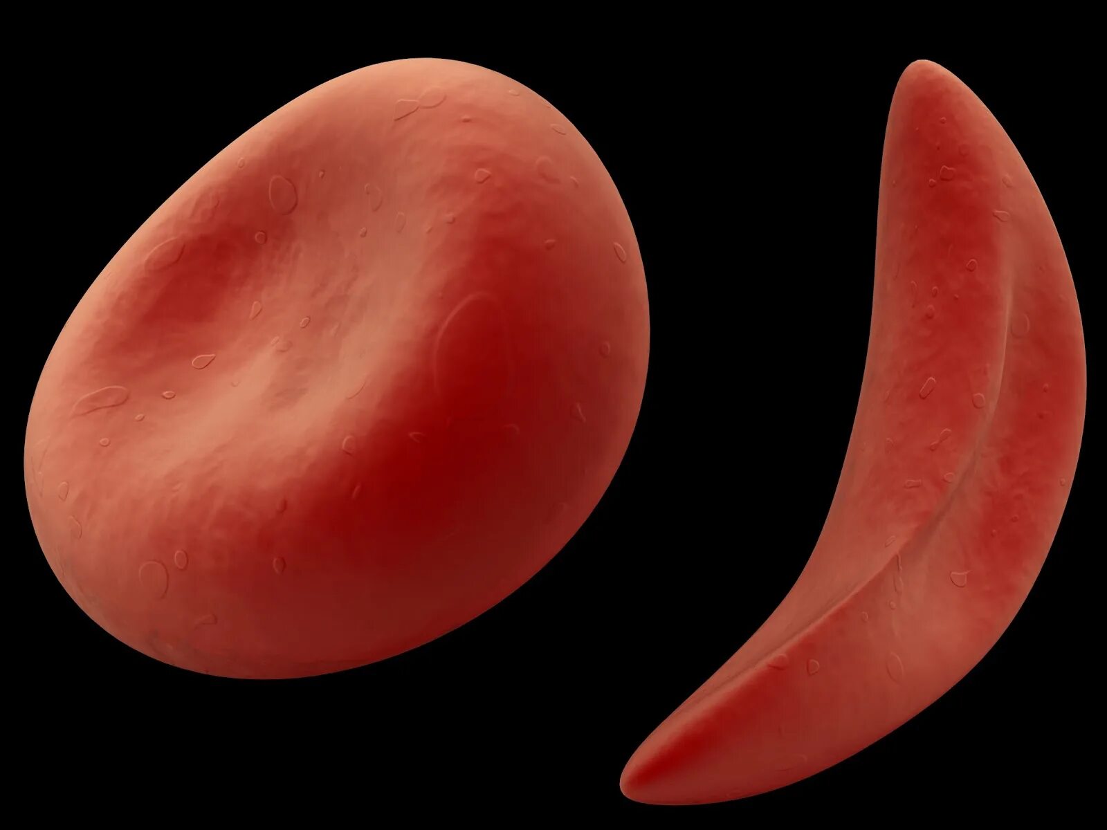 Серповидноклеточная анемия формы. Клеточная анемия серповидноклеточная. Эритроциты при серповидноклеточной анемии. Сероповидно клеточная анемия. 1) Серповидно-клеточная анемия.