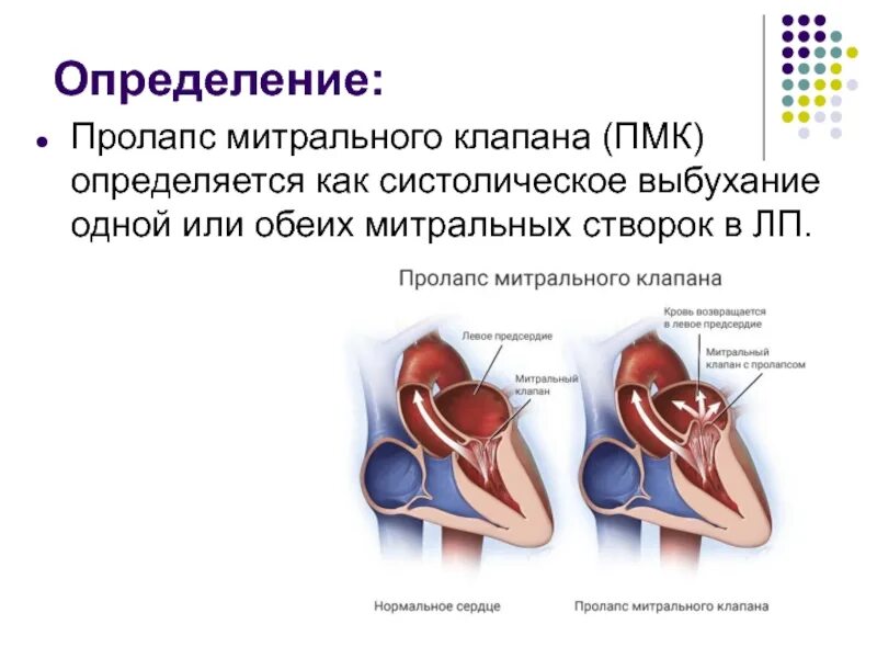 Что такое пролапс митрального клапана. Пролапс митрального клапана (ПМК). Пролапс передней створки митрального клапана. Пролапс передней створки митрального клапана до 5 мм. Пролапс створок трикуспидального клапана.