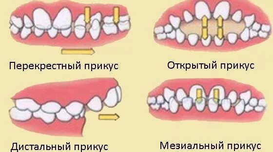 Зубы при закрытом рте. Трансверзальные аномалии прикуса перекрестный прикус. Прикус мезиальный открытый перекрестный. Прогенический прикус аномалия зубов. Мезиальный прикус зубов.