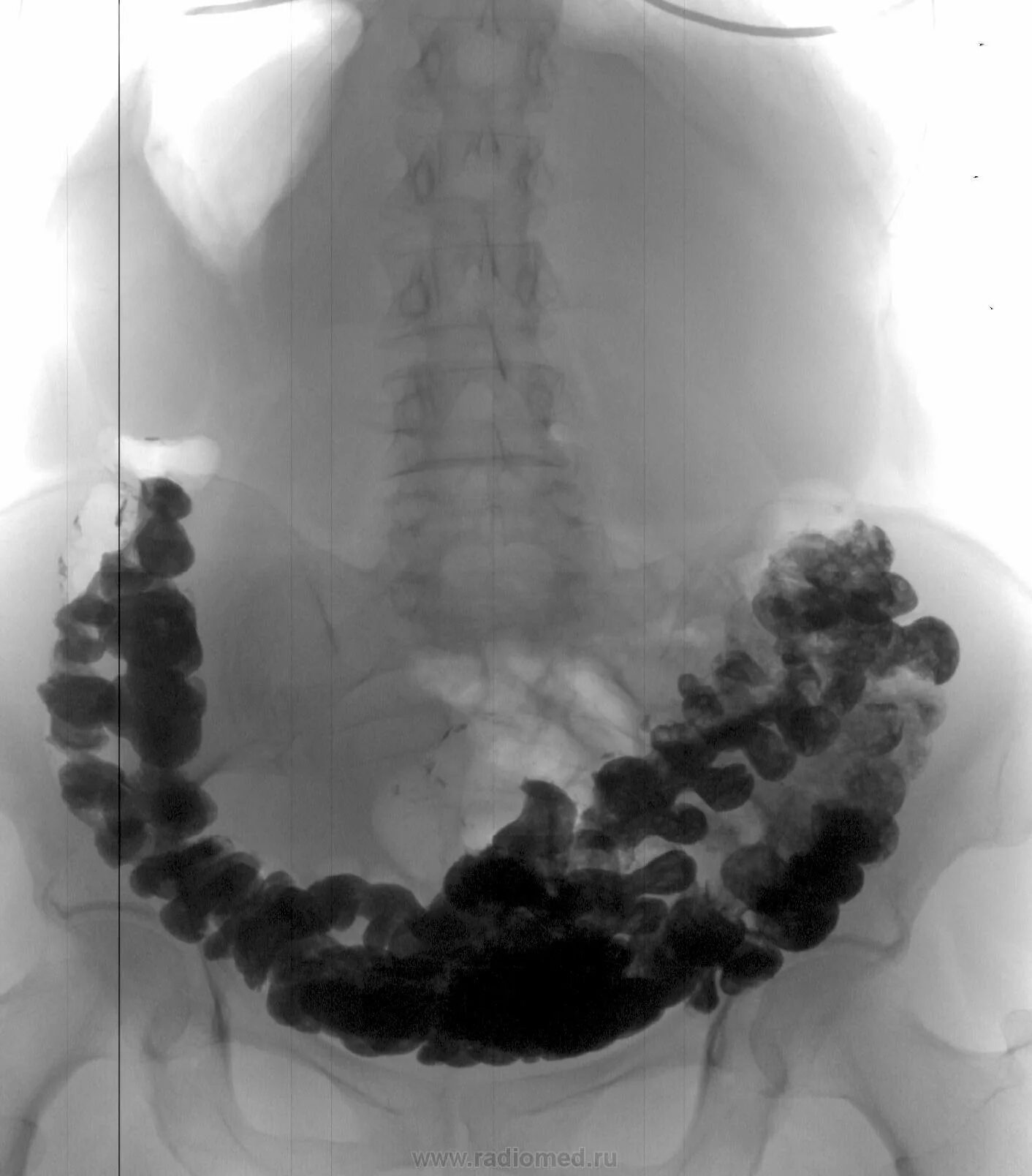 Как очистить кишечник от камней. Каловый перитонит рентген. Толстый кишечник каловые камни рентген. Каловые массы в кишечнике на рентгене. Каловые камни в кишечнике рентген.