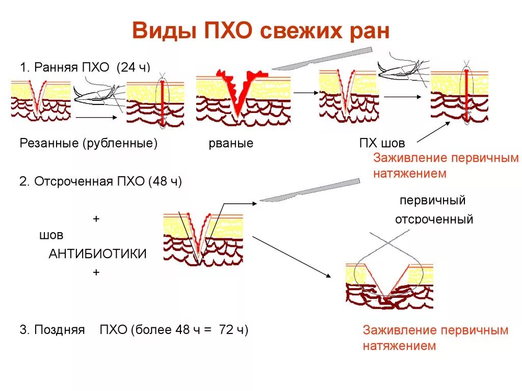 Этапы заживления ран. Типы хирургической обработки раны. Первичная хирургическая обработка раны виды. Заживление РАН. Фазы заживления РАН. Первичная хирургическая обработка наложение швов.