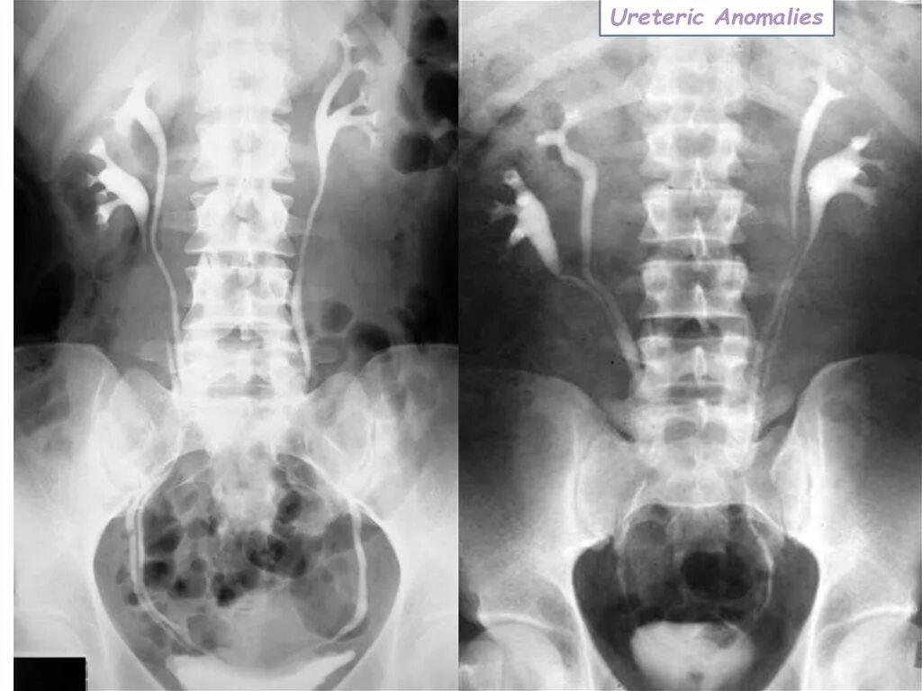 Два мочеточника. Удвоение почки рентген. Неполное удвоение почки рентген. Неполное удвоение почки урография. Неполное удвоение лоханки почки.