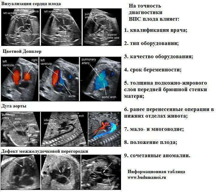 Четырехкамерный срез сердца. УЗИ сердца плода норма показателей. Сердце плода на УЗИ норма. 4 Камерный срез сердца у плода норма. Эхография порока сердца.