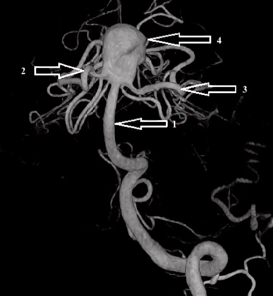 Аневризма стент. Аневризма бифуркации основной артерии. Мешотчатая аневризма основной артерии. Аневризма бифуркации базилярной артерии. Фузиформная аневризма бифуркации основной артерии.