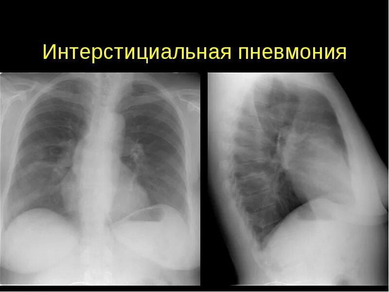 Болезни легких у детей. Интерстициальная пневмония рентген. Рентген при интерстициальной пневмонии. Интерстициальная пневмония у детей рентген. Интерстициальная пневмония и очаговая.