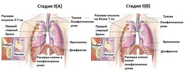 Рак легкого симптомы сколько живут. Опухоль легких 2 стадия. Стадии опухоли легкого. Онкология легких стадии. Онкология лёгких 3 стадии.