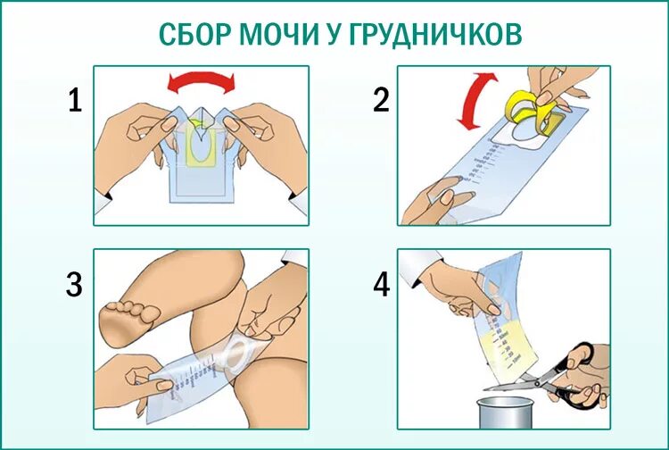 Сбор мочи у новорожденных мальчиков мочеприемник. Сбор мочи у детей раннего возраста с помощью мочеприёмника. Мочесборник для новорожденных мальчиков для сбора мочи. Алгоритм сбора мочи у детей с мочеприемником.