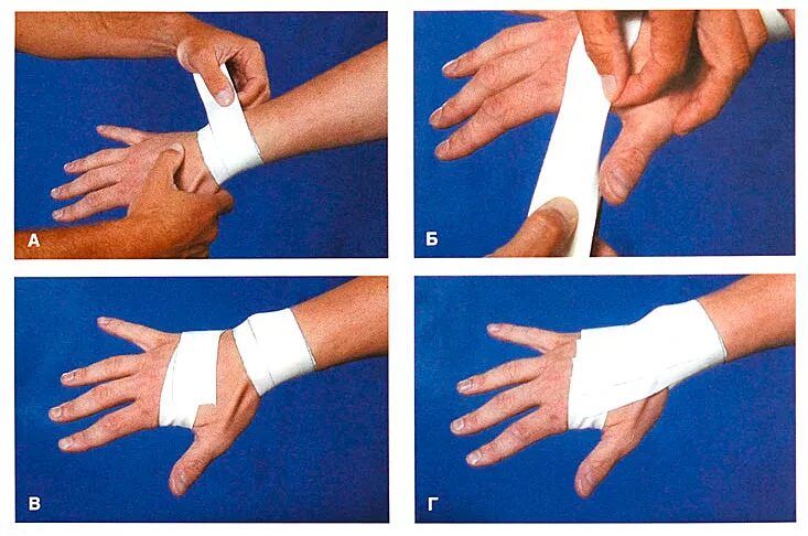 ушиб запястья руки что делать. хроническая травма кисти. симптоматика при переломе кисти. растяжение сухожилий кисти руки. крепитирующий тендовагинит предплечья.