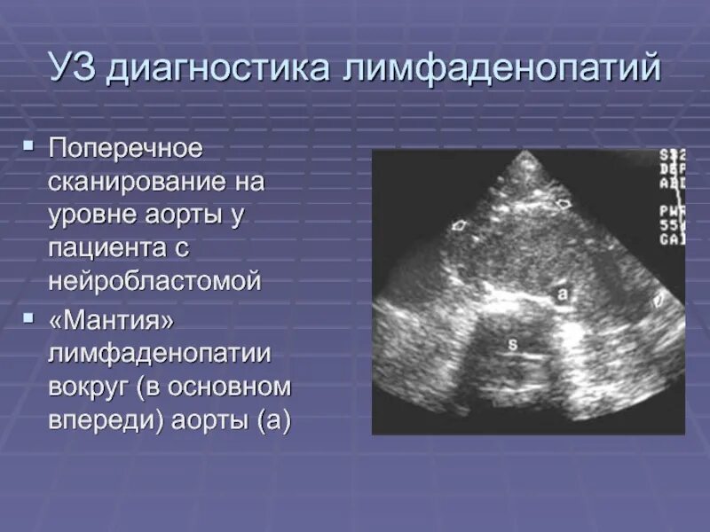 Узи где находится. Узи лимфоузлов брюшной полости. забрюшинные лимфоузлы на узи. лимфоузлы брюшной полости на узи. узи лимфатических узлов брюшной полости и забрюшинного пространства.