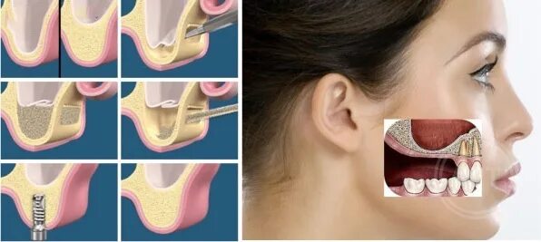 Синус-лифтинг (костная пластика, остеопластика). Открытый и закрытый синус лифтинг. Операция открытый синус лифтинг. Синус десны