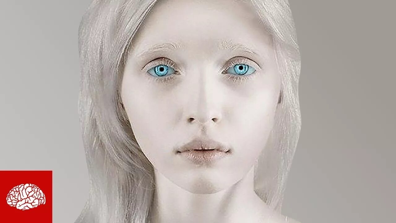 Европеоид альбинос. Якутка-альбинос Нарияна. Девушка альбинос. Белые глаза у человека.
