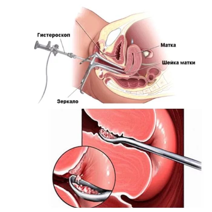 Полип эндометрия гистероскопия. Резектоскопия полипа эндометрия. Гистероскопия шейки матки. Операционная гистероскопия матки. Гистероскопия операция удаления полипа