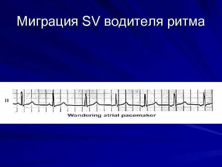 Миграция сердца. Миграция сердца. Миграция наджелудочкового водителя ритма на экг. Миграция сердца. Миграция сердца.