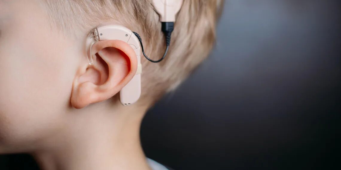 Среднее нарушение слуха. Кохлеарная имплантация Cochlear. Medel кохлеарный имплант. Слуховой аппарат кохлеарный имплант. Слуховые импланты Кохлер.