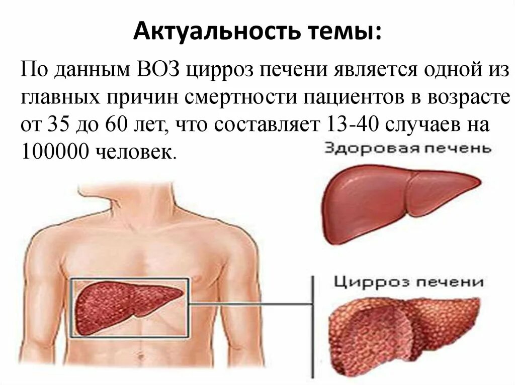 Болезнь печен. Заболевание цирроз печени. Мелкоузловой цирроз печени. Клинические симптомы цирроза печени. Гепатитный цирроз печени симптомы.