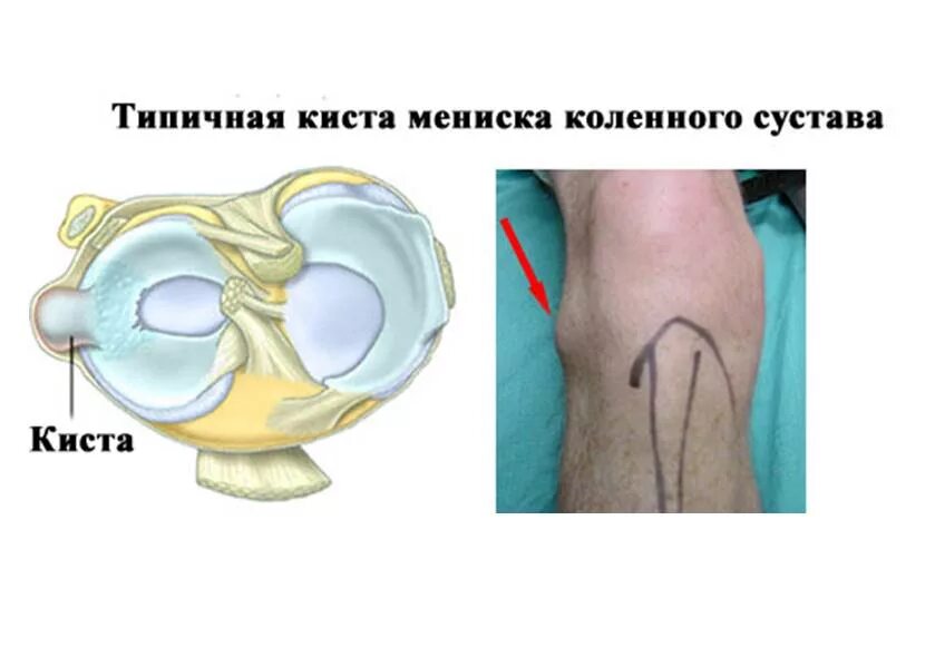 Киста беккера в коленном суставе. Киста медиального мениска. Бурсит коленного сустава жидкость. Синовиальная киста бейкера. Киста беккера в коленном суставе.