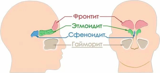 Синусит фронтит этмоидит. Гайморит фронтит сфеноидит.