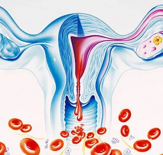Кровотечение вне цикла причины. Аномальные маточные кровотечения. Альгодисменорея и кольпит. Обильные месячные при цистите. Аномальное маточное кровотечение Palm.