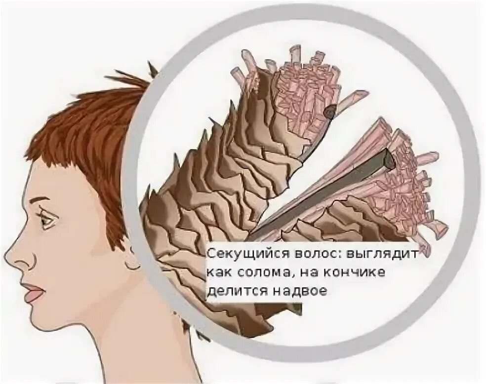 Как вылечить ломкость волос. Секущиеся волосы. секущиеся кончики волос под микроскопом. как выглядят секущиеся волосы. как изнутри выглядит секущийся волос.