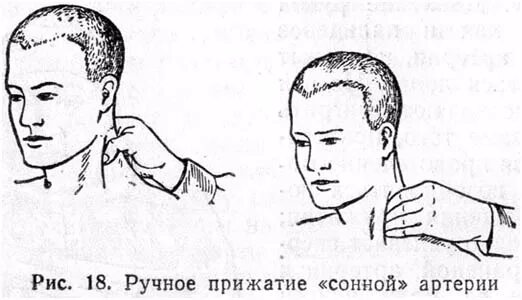 Чем можно усыпить человека. Сонные точки. Точки для усыпления человека. Сонные точки на теле человека.