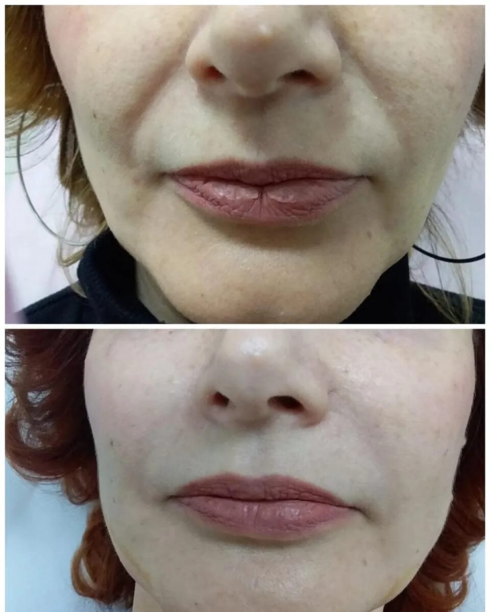 Коррекция носогубных складок. Контурная носогубки носогубки пластика. Контурная пластика носогубных складок. Косметолог носогубные складки. Филлинг носогубных складок.