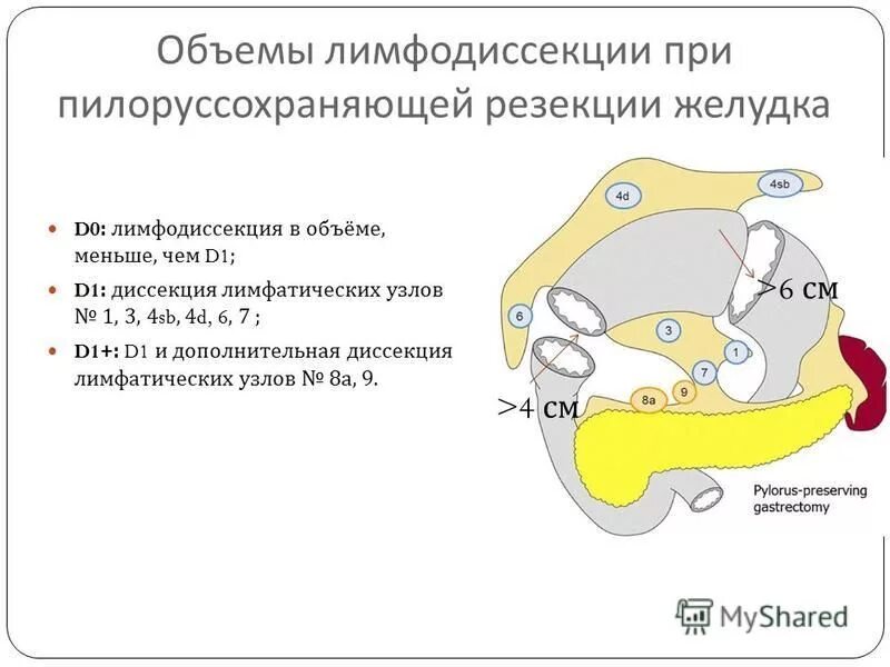 Лимфодиссекция при раке. Объемы лимфодиссекции. Гастрэктомия лимфодиссекция d2. Резекция желудка с лимфаденэктомией. Лимфодиссекция в объеме d2.