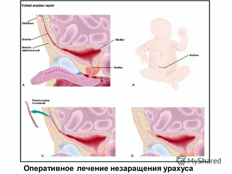 аномалии урахуса и желточного протока. аномалия мочевого протока урахуса. пороки развития урахуса. урахус это. аномалия мочевого протока урахуса.