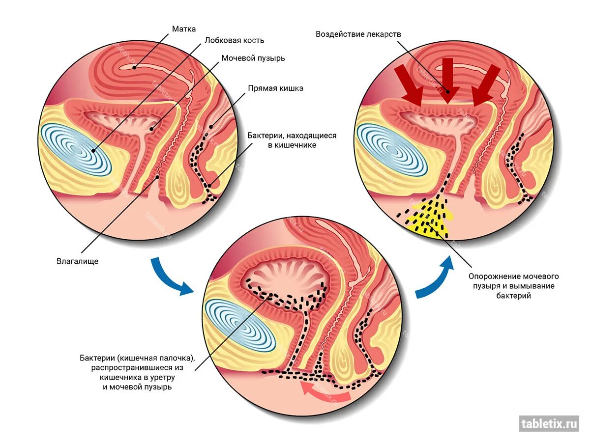 Заболевание цистит болезнь. Цистит вызывается бактериями. Цистит у женщин анатомия.