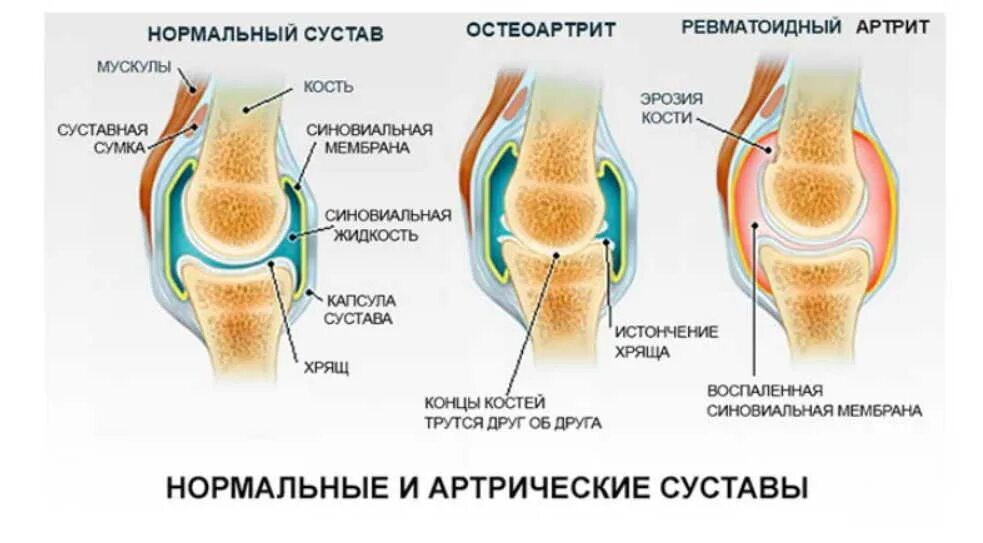 Артрит греть суставы. Ревматоидный артрит синовиальная жидкость. Суставная синовиальная жидкость коленного сустава. Схема суставов ревматоидный артрит. Артроидный артрит коленного сустава.