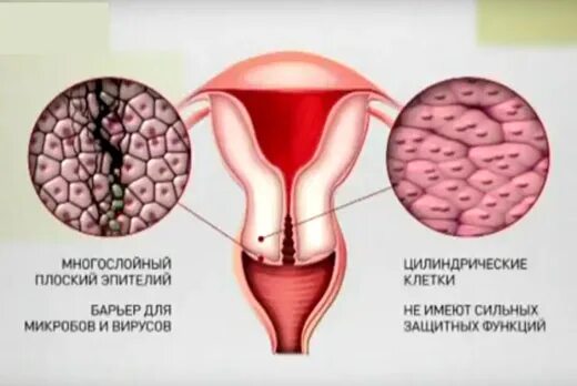 Полип цервикального канала. Лечение цервикального канала у женщин